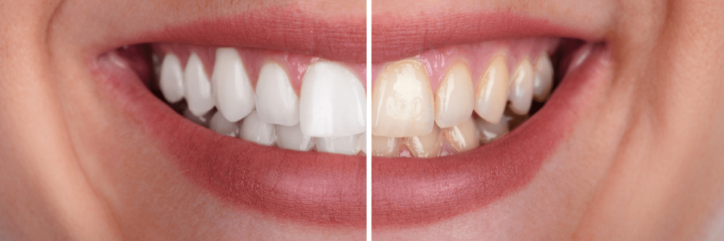 Fast, professional teeth whitening
