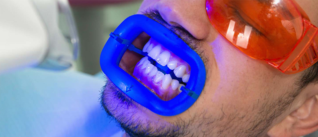 Explore cutting-edge teeth whitening