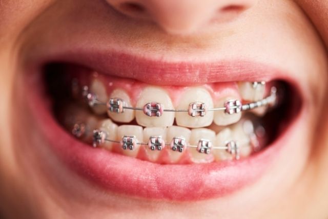 High-Quality Braces