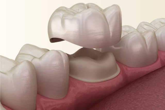 Dental Crowns