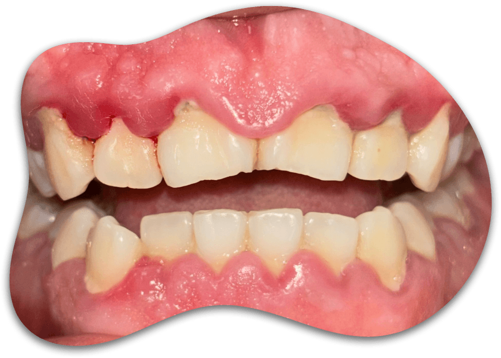 CASE 01, From painful inflammation to healthy gums
