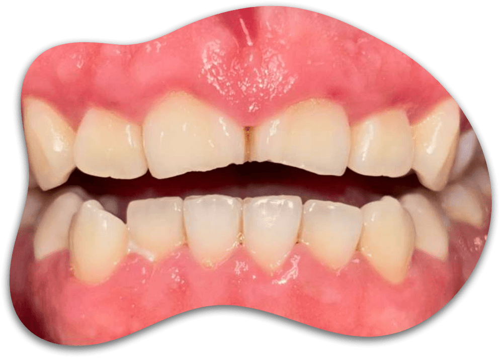 CASE 01, From painful inflammation to healthy gums