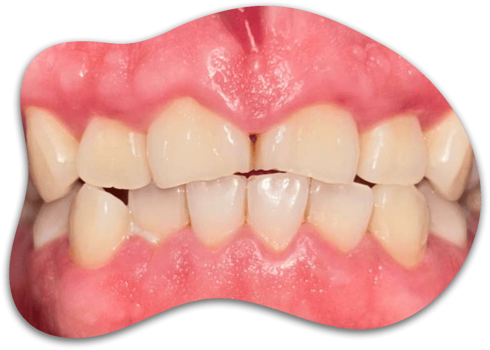 CASE 01, From painful inflammation to healthy gums
