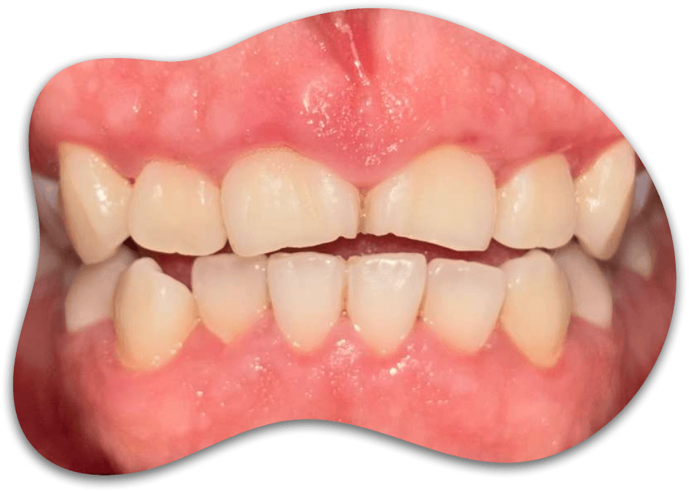 CASE 01, From painful inflammation to healthy gums