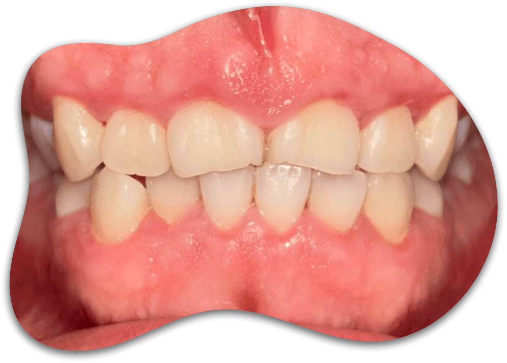 CASE 01, From painful inflammation to healthy gums