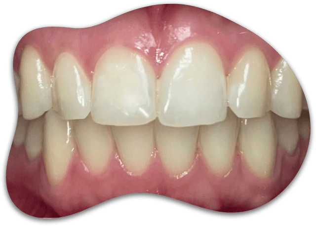 CASE 01, Super White Smiles