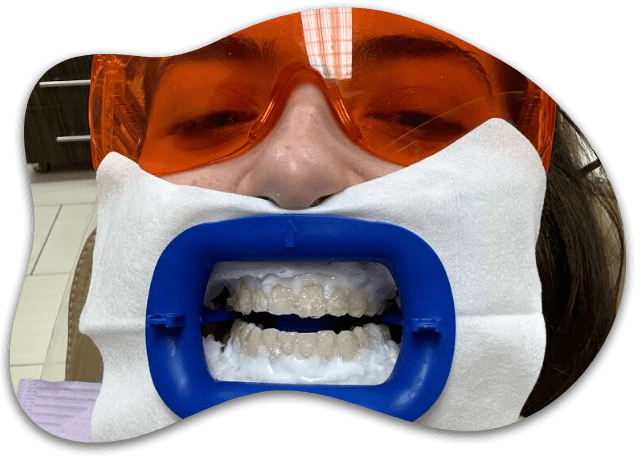 CASE 01, Super White Smiles