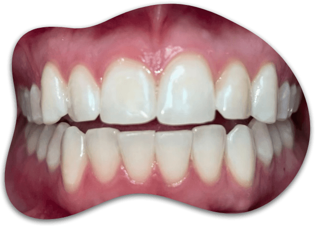 CASE 01, Super White Smiles