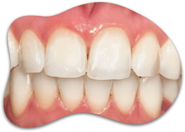 CASE 01, Super White Smiles